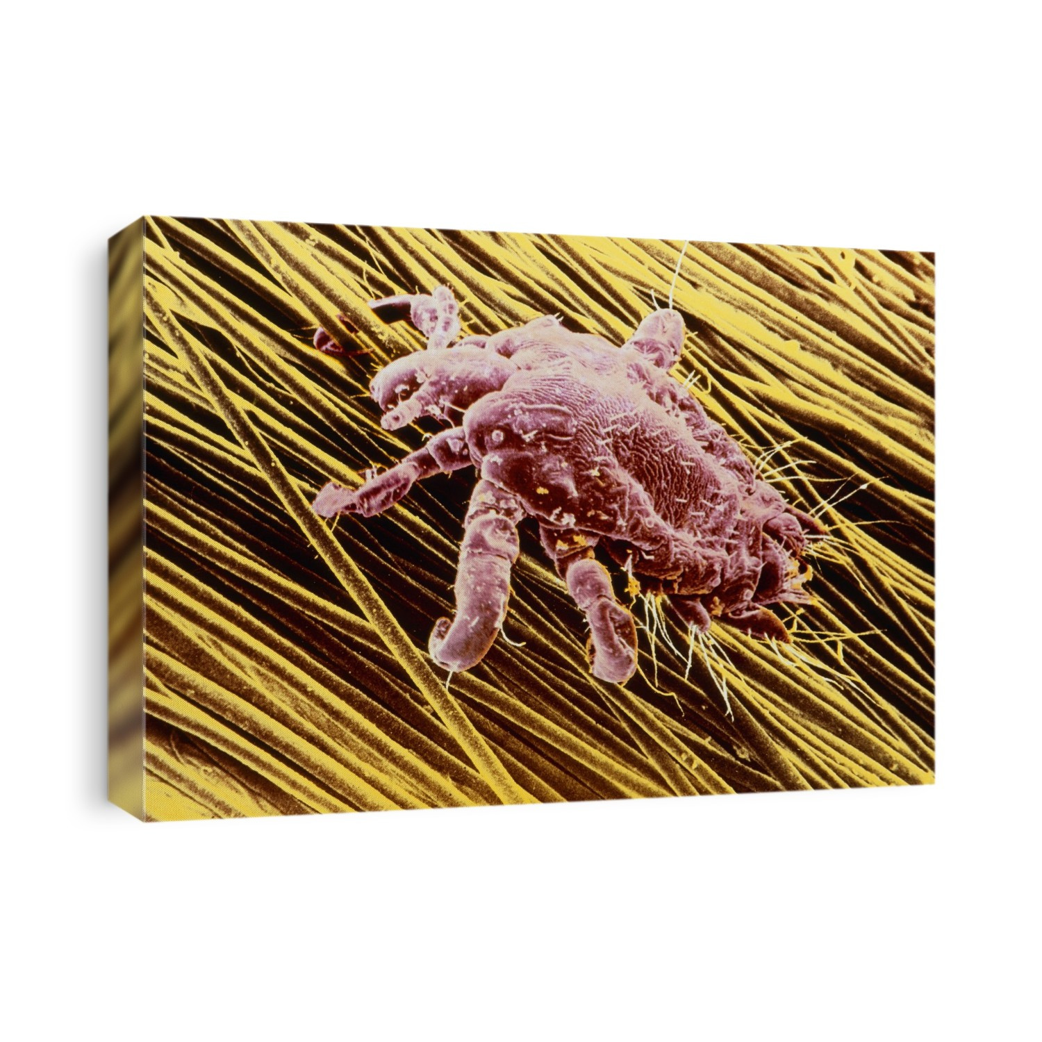 False-colour scanning electron micrograph (SEM) of the pubic louse, Phthirus pubis, also known as the crab louse, on pubic hair. An infestation of P. pubis causes pediculosis, the symptoms of which are severe itching & a rash. The lice suck blood, feeding 5 times a day. They spread through sexual contact & via bedding or clothing. Each of the louse's 6 legs terminates in a massive claw, which folds inward to meet a thumb-like projection on the opposite side. The louse climbs and swings through its hairy habitat, locking into position when it is disturbed, for instance by scratching or washing. Magnification: x25 at 6x4.5cm size.